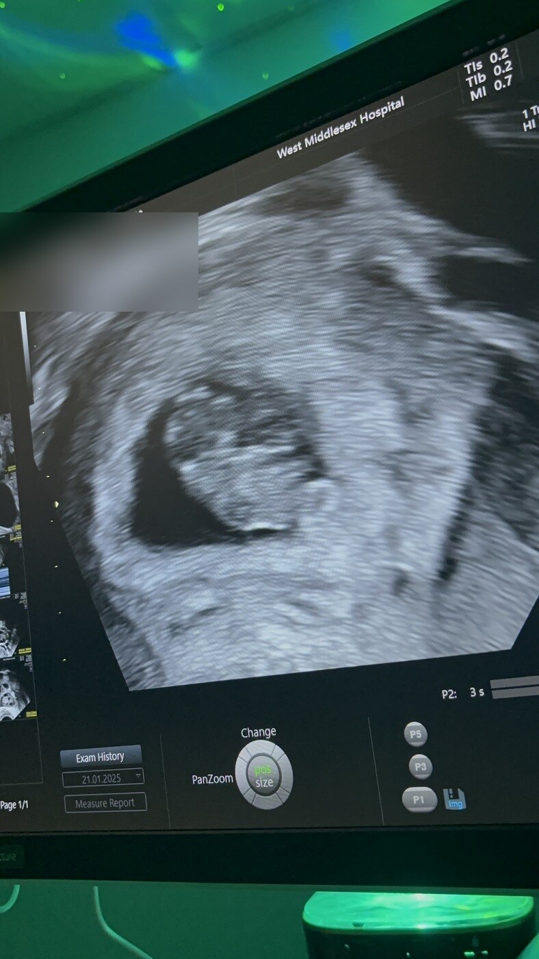 An ultrasound scan with personal information blurred